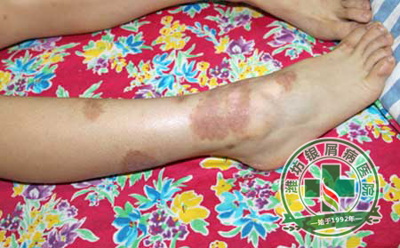 银屑病发病的外界因素