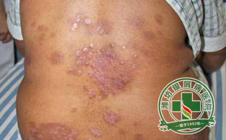 秋季预防银屑病的方法