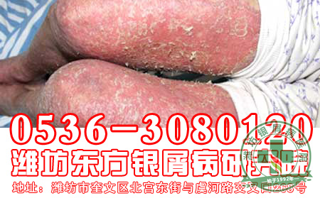 银屑病患者如何科学护理疾病