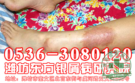 银屑病患者穿衣有什么讲究