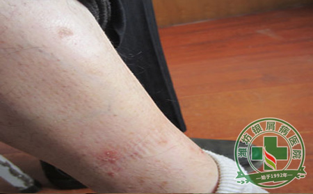 银屑病治疗要注意“三不”