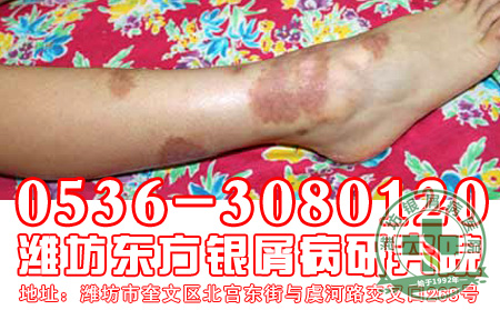女性银屑病患者怀孕后症状会加重吗