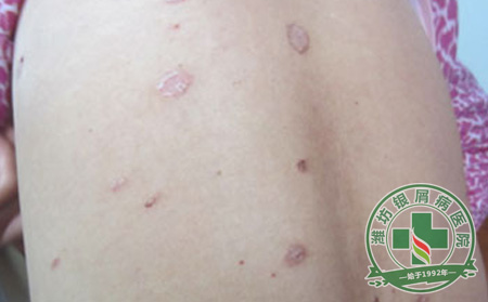 牛皮癣要怎么治疗可以