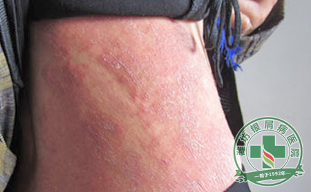 牛皮癣患者冬季护理指南