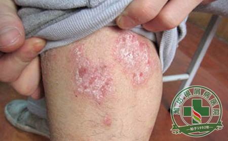 济南牛皮癣医院讲解牛皮癣患者冬季护理