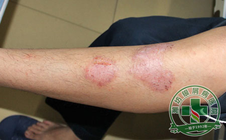 牛皮癣患者可以吃栗子吗