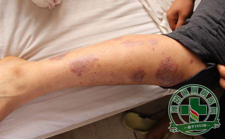 为什么吃了中药后反而牛皮癣病情加重了呢