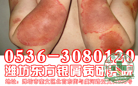 牛皮癣妈妈可以母乳喂养吗