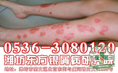 牛皮癣患者如何提高自身的免疫力呢