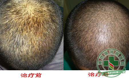 牛皮癣病情会随什么而变化