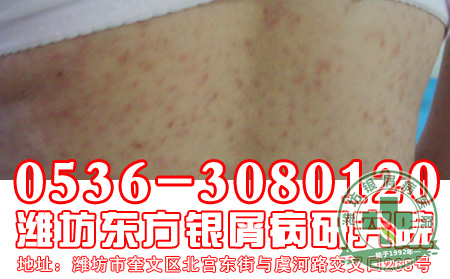 银屑病患者能洗淀粉浴吗?