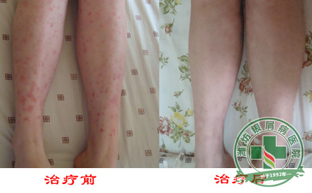 冬季防治牛皮癣病症发生需做什么