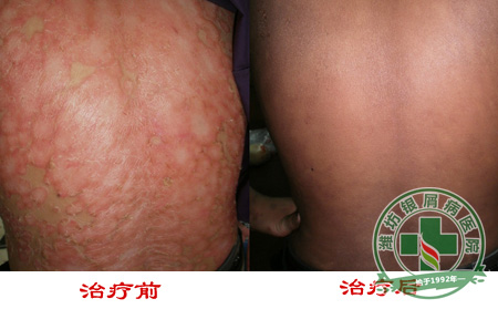 寻常型牛皮癣平时有什么预防措施