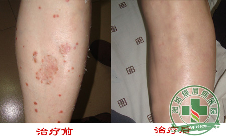 怎样缓解银屑病造成的皮肤瘙痒