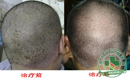 儿童银屑病是因为传染才发病的吗？