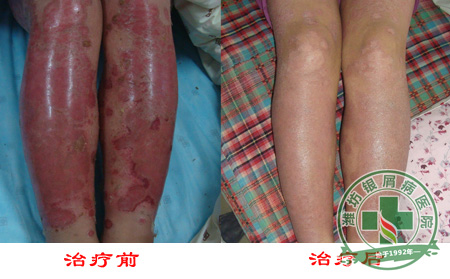 如何通过病因来防治牛皮癣病情发生