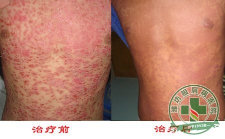 如何通过病因来防治牛皮癣病情发生