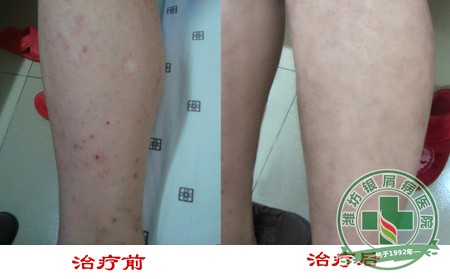 济南银屑病指出精神因素与疾病有什么关系