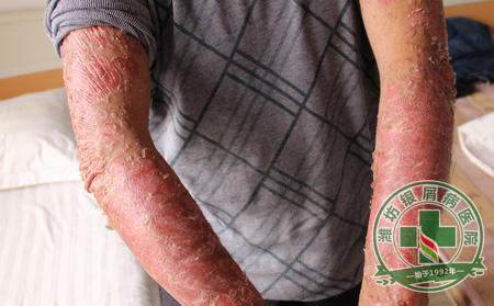 牛皮癣怎样治疗才能多数去根呢