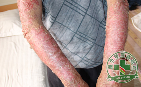 牛皮癣怎样治疗才能多数去根呢