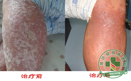 济南银屑病帮您解决失眠的困扰