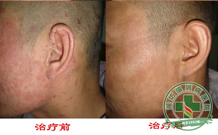 济南牛皮癣医院讲解头部有症状怎么办