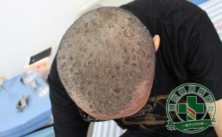 牛皮癣患者吃菠萝可以吗-济南银屑病可以的医院