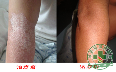 银屑病治疗银屑病确诊银屑病病情表现