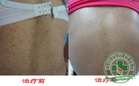 有脓疱病型牛皮癣要怎么去护理-济南牛皮癣医院