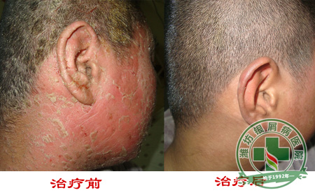 济南治疗银屑病诉说银屑病常识介绍