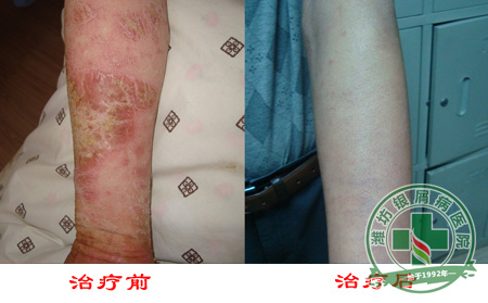 遇到牛皮癣总是反复该怎么办-济南如何治疗牛皮癣