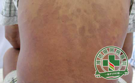 牛皮癣护理