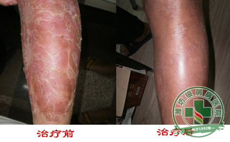 牛皮癣患者要保持规律的生活习惯-济南牛皮癣医院