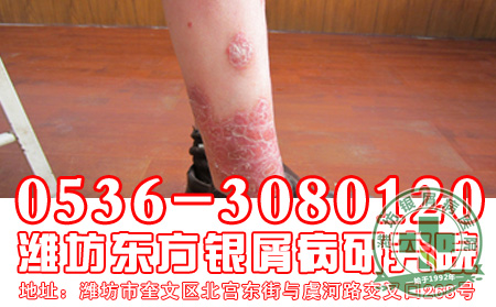 牛皮癣对患者的身体危害大吗-济南皮肤病医院