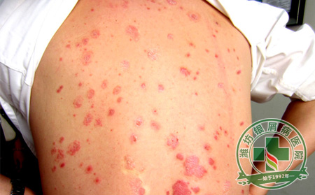 什么样的其他方治疗牛皮癣更可以-山东银屑病医院