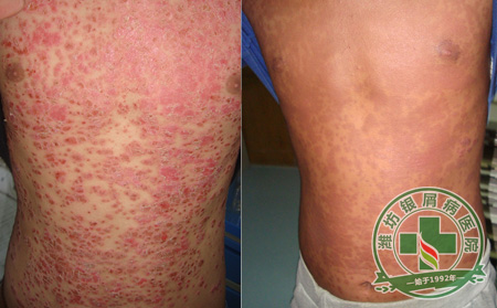 什么样的其他方治疗牛皮癣更可以-山东银屑病医院