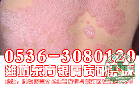 治疗牛皮癣一般都有什么方法-济南银屑病专科医院