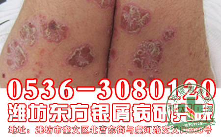 得了牛皮癣会有生命危险-济南牛皮癣医院