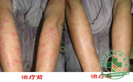 济南银屑病的收费标准是什么呢