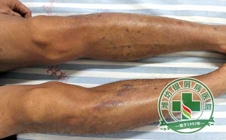 银屑病发病原因