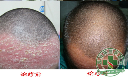  简述：寻常型银屑病可以发部位