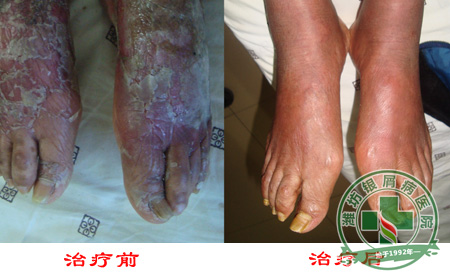 SP-R绿色净肤疗法——寻常型银屑病治疗