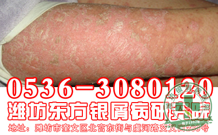 银屑病初期症状是什么？