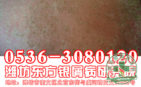 怎样预防银屑病的复发？