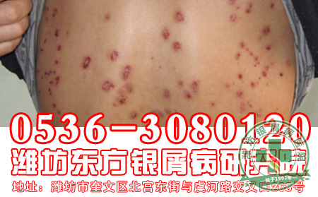 银屑病症状需要注意哪些？