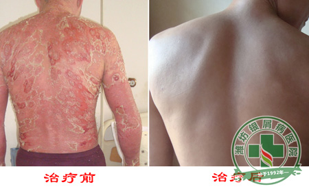 女性银屑病日常生活中应该怎样护理？