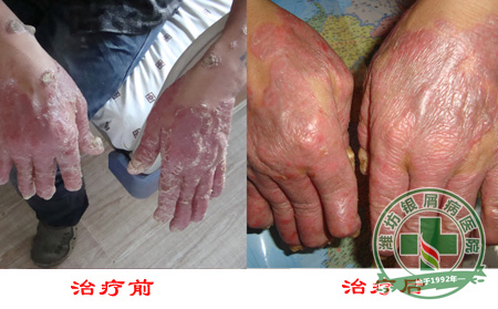 女性银屑病日常生活中应该怎样护理？