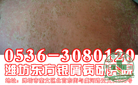 银屑病会影响正常夫妻关系吗?