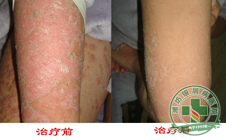 男性银屑病诱发因素有哪些？