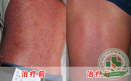 银屑病局部治疗前后